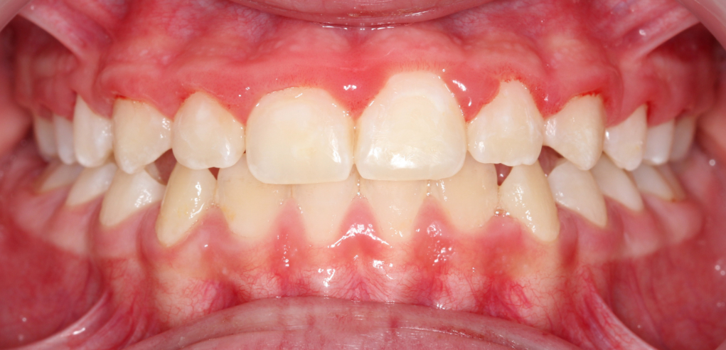 Antosia - zdjęcie po