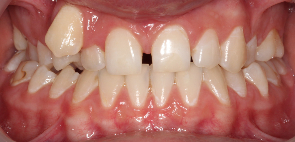 Wiktoria - zdjęcie przed