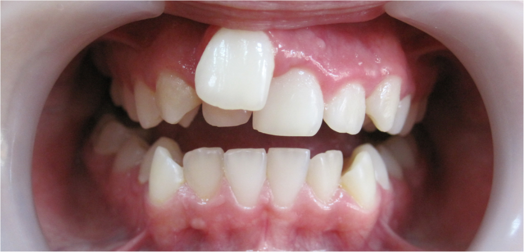 Mocne stłoczenie zębów w łuku dolnym