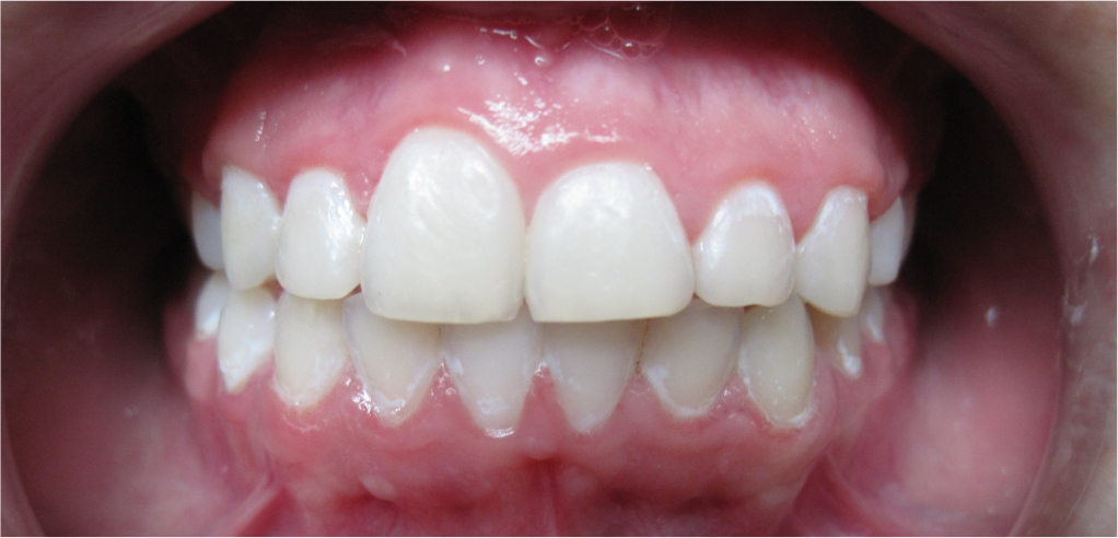 Mocne stłoczenie zębów w łuku dolnym